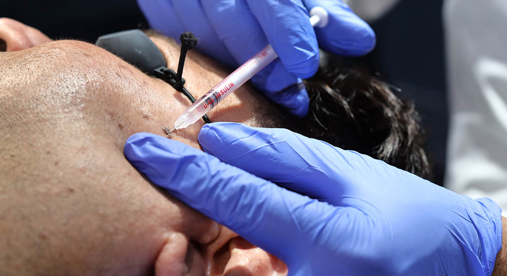 Best Mole Removal Surgery