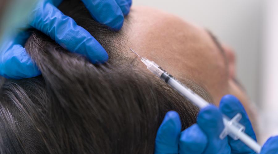Transform Your Hair with Ojasvi Dermatology Clinic's Hair Transplant Services 